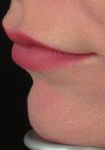 Mastering the art of lip rejuvenation: identifying patterns and techniques