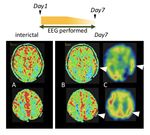 Simple partial status epilepticus presenting with jargon aphasia and focal hyperperfusion demonstrated by ictal pulsed arterial spin labeling MRI ...