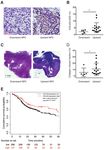 Differential expression of COL4A3 and collagen in upward and downward progressing types of nasopharyngeal carcinoma