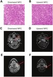 Differential expression of COL4A3 and collagen in upward and downward progressing types of nasopharyngeal carcinoma