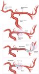 Hybrid microcatheter angioplasty for refractory cerebral vasospasm