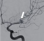 Hybrid microcatheter angioplasty for refractory cerebral vasospasm