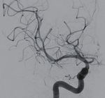 Hybrid microcatheter angioplasty for refractory cerebral vasospasm