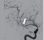 Hybrid microcatheter angioplasty for refractory cerebral vasospasm
