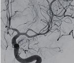 Hybrid microcatheter angioplasty for refractory cerebral vasospasm