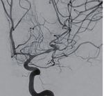 Hybrid microcatheter angioplasty for refractory cerebral vasospasm