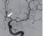 Hybrid microcatheter angioplasty for refractory cerebral vasospasm