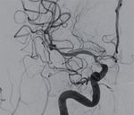Hybrid microcatheter angioplasty for refractory cerebral vasospasm