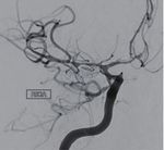 Hybrid microcatheter angioplasty for refractory cerebral vasospasm