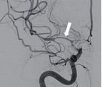 Hybrid microcatheter angioplasty for refractory cerebral vasospasm
