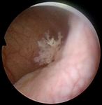 A transfer-learning approach for lesion detection in endoscopic images from the urinary tract