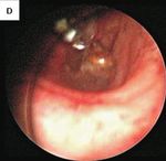 Removal of a Bronchial Foreign Body by Bronchoscopic Cryotherapy: A Case Study