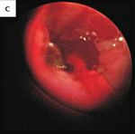 Removal of a Bronchial Foreign Body by Bronchoscopic Cryotherapy: A Case Study