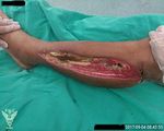 Salvage of Lower Limb in Delay-Diagnosed Popliteal Artery Transection Caused by Blunt Trauma