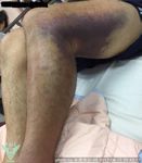 Salvage of Lower Limb in Delay-Diagnosed Popliteal Artery Transection Caused by Blunt Trauma
