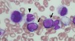 Case Report Successful Treatment of Myeloid Sarcoma in an Elderly Patient with Myelodysplastic Syndrome with Reduced-Dose Azacitidine