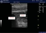 Sonographic Approach of the Lumbar Portion of the Psoas Muscle Abordaje ecográfico de la porción lumbar del músculo psoas