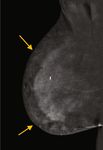 Case Report Contrast-Enhanced Mammography in the Diagnosis of Breast Angiosarcoma