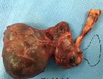 Water Clear Cell Parathyroid Adenoma: A Report of Two Cases - Arab Gulf Journal of ...