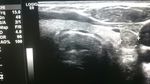 Water Clear Cell Parathyroid Adenoma: A Report of Two Cases - Arab Gulf Journal of ...