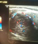 Water Clear Cell Parathyroid Adenoma: A Report of Two Cases - Arab Gulf Journal of ...