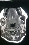 Water Clear Cell Parathyroid Adenoma: A Report of Two Cases - Arab Gulf Journal of ...
