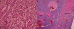 Water Clear Cell Parathyroid Adenoma: A Report of Two Cases - Arab Gulf Journal of ...