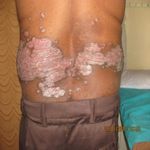 A Retrospective Study of Histopathology of Psoriasis Vulgaris in a Tertiary Hospital - Journal of Medical ...