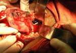 Rare Presentation of Chorioadenoma Destruens as Acute Haemoperitoneum Mimicking Ruptured Ectopic Pregnancy