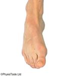 Achilles Tendinopathy - Musculoskeletal Physiotherapy Information for patients - NHS TIMS