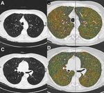 Lung Volume Reduction Surgery in Patients with Homogeneous Emphysema