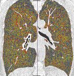 Lung Volume Reduction Surgery in Patients with Homogeneous Emphysema