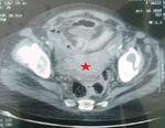 Small Bowel Gist in a Patient with Neurofibromatosis Type 1: Revealed by Acute Abdominal Surgery: A Case Report