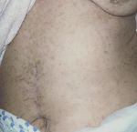 Small Bowel Gist in a Patient with Neurofibromatosis Type 1: Revealed by Acute Abdominal Surgery: A Case Report