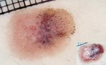 Dermatoscopic pitfalls in differentiating pigmented Spitz naevi from cutaneous melanomas