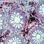 Diagnosis and Therapy of Microscopic Colitis with Presence of Foamy Macrophages in Children