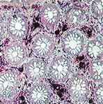 Diagnosis and Therapy of Microscopic Colitis with Presence of Foamy Macrophages in Children