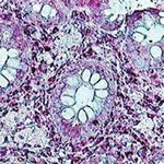 Diagnosis and Therapy of Microscopic Colitis with Presence of Foamy Macrophages in Children