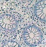 Diagnosis and Therapy of Microscopic Colitis with Presence of Foamy Macrophages in Children