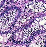 Diagnosis and Therapy of Microscopic Colitis with Presence of Foamy Macrophages in Children