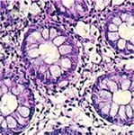 Diagnosis and Therapy of Microscopic Colitis with Presence of Foamy Macrophages in Children
