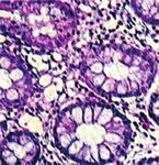 Diagnosis and Therapy of Microscopic Colitis with Presence of Foamy Macrophages in Children