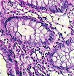 Diagnosis and Therapy of Microscopic Colitis with Presence of Foamy Macrophages in Children