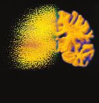 Diagnosis and Therapy of Microscopic Colitis with Presence of Foamy Macrophages in Children