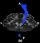 Corticospinal Tract (CST) reconstruction based on fiber orientation distributions (FODs) tractography