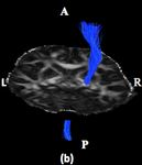 Corticospinal Tract (CST) reconstruction based on fiber orientation distributions (FODs) tractography