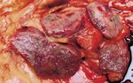 Generalized sarcoidosis in two horses - ild care foundation