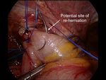 MIS revisional surgery for gastro-esophageal reflux disease: how I do it