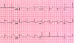 T2DM PATIENTS ACROSS THE CARDIOVASCULAR RISK CONTINUUM - HEART A PRACTICAL GUIDE FOR THE PHARMACOLOGICAL MANAGEMENT OF