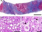 Autochthonous hepatitis E as a cause of acute-on-chronic liver failure and death: histopathology can be misleading but transaminases may provide a ...